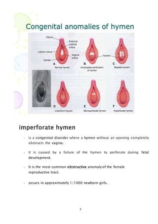 hymen pictures|Hymen : Location, Pictures, Types, Repair Broken。